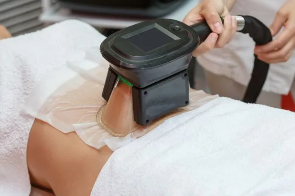Image of person having fat freezing treatment to help weight gain Telford
