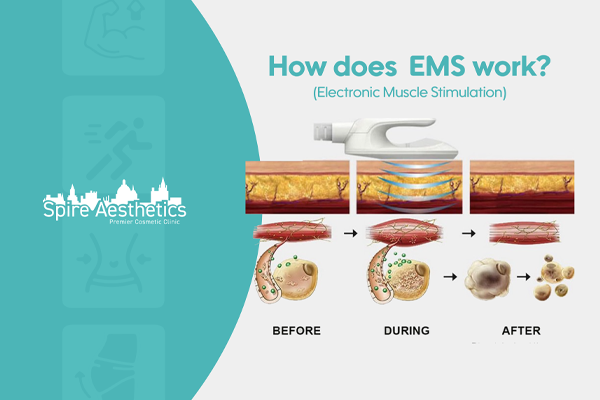 EMS treatment for post pregnancy weight loss treatment Telford