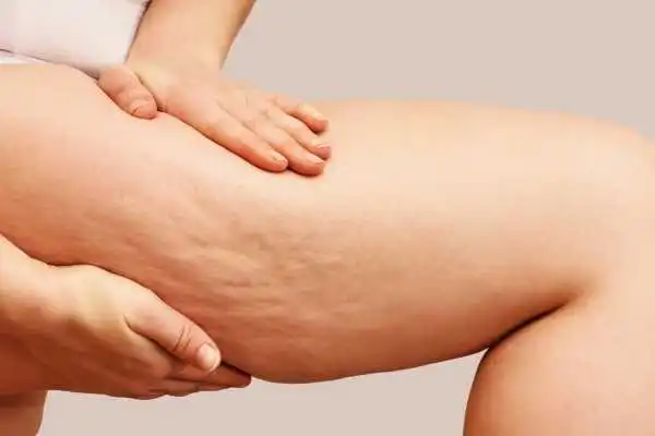 Image of woman showing leg with cellulite Telford