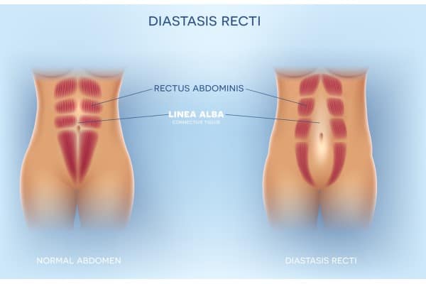 What Non-Surgical Options Are Available for Diastasis Recti Telford?