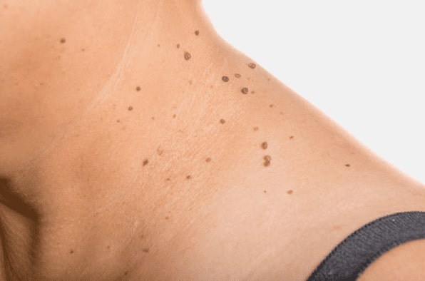 Are you looking for easy skin tag removal Telford - then contact Spire today!
