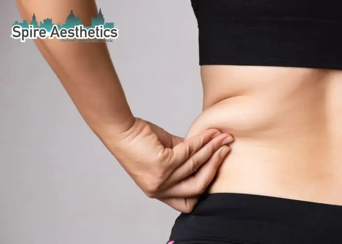 Image of woman pinching fat on their hips Telford. Fat Freezing treatment