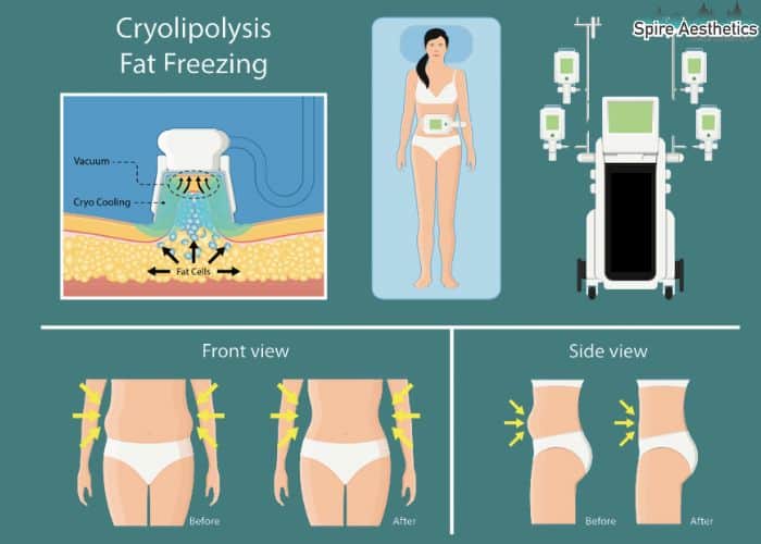 Image of diet and fat freezing combined for best results for Spire Aesthetics Telford