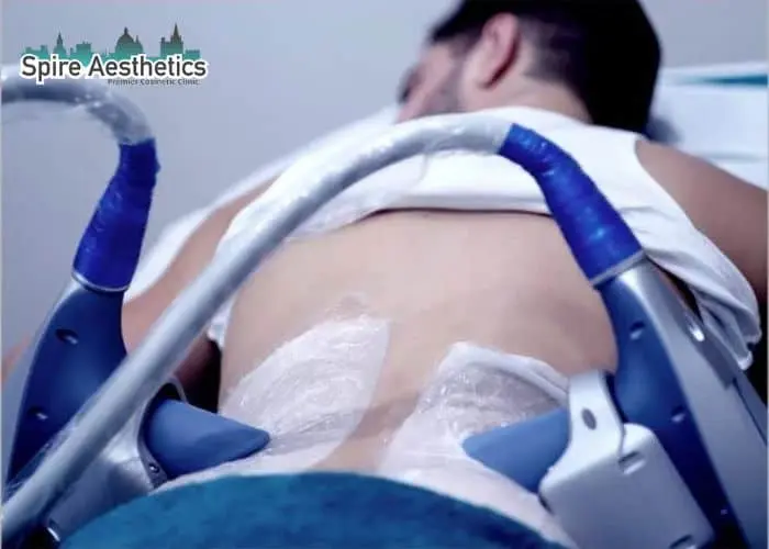 Man having fat freezing treatment done on love handles before a competitions Telford to create a sculpted look.