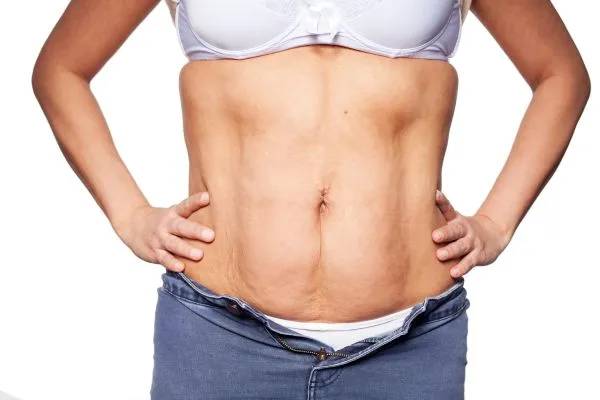 sagging skin on woman's stomach after weight loss injections Telford