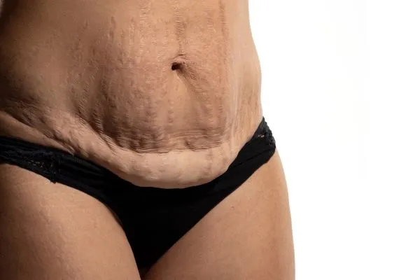 Image of womans stomach after weight loss injections Telford showing saggy skin