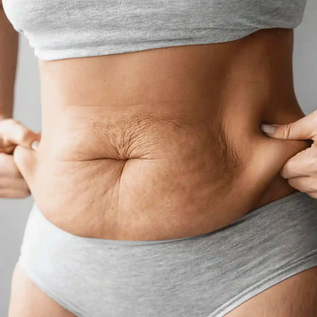 Is It Normal to Have Loose Skin After Pregnancy Telford?
