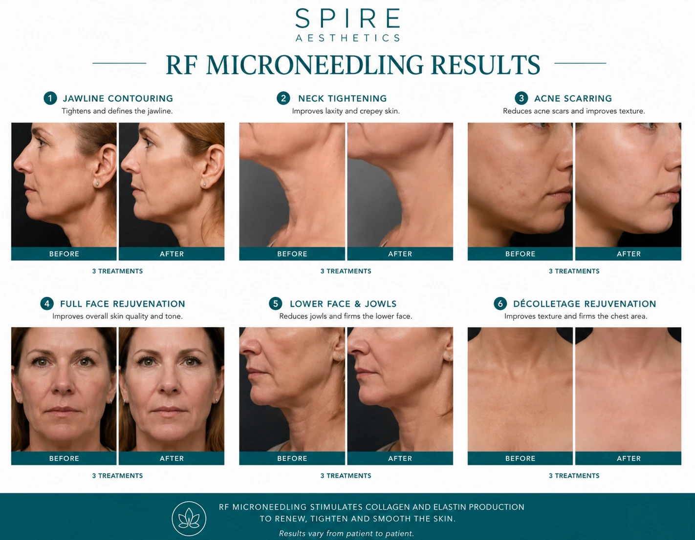 RF Microneedling Skin tightening Telford results