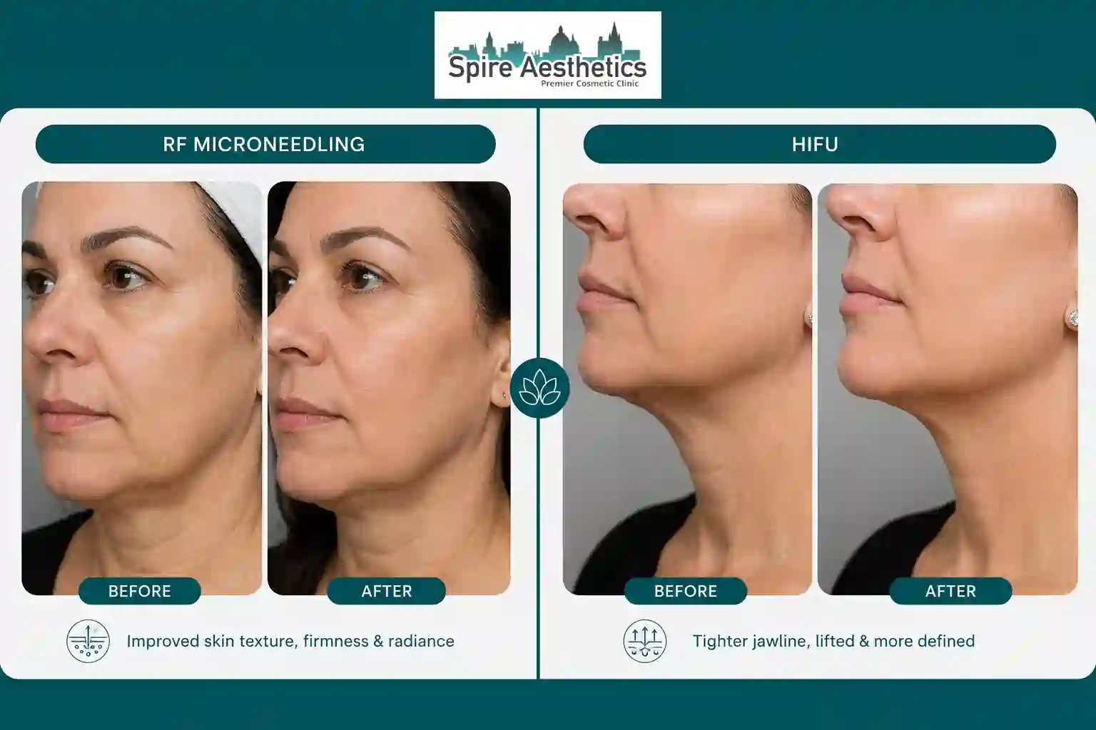 Can RF Microneedling and HIFU Be Combined Telford?