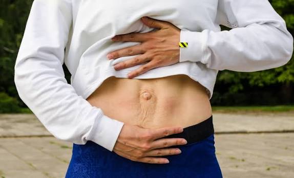 When Could Diastasis Recti Be the Missing Piece of the Puzzle Telford?