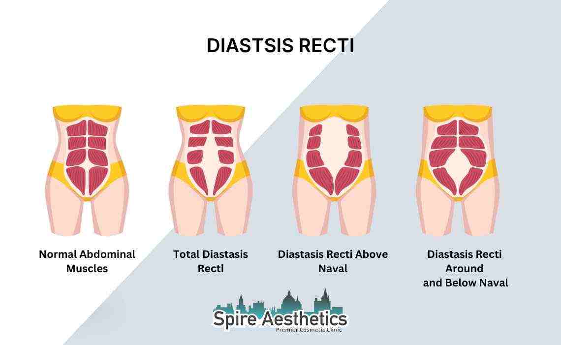 Is Non-Surgical Diastasis Recti Treatment Right for You? Common Concerns Answered Telford